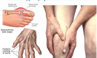 Le CBD peut-il soulager les symptômes de l'arthrite ? Le CBD peut-il soulager les symptômes de l'arthrite ?