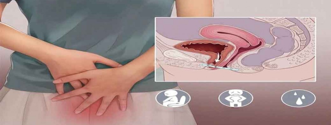 NMN’s Powerful Benefits: Improving Pelvic Floor Dysfunction in Women NMN’s Powerful Benefits: Improving Pelvic Floor Dysfunction in Women